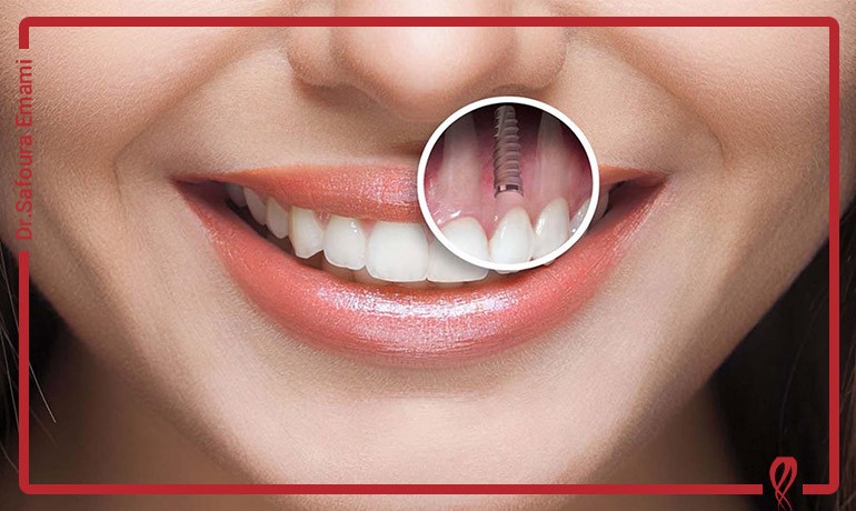 مقایسه تکنیک های مختلف کاشت ایمپلنت